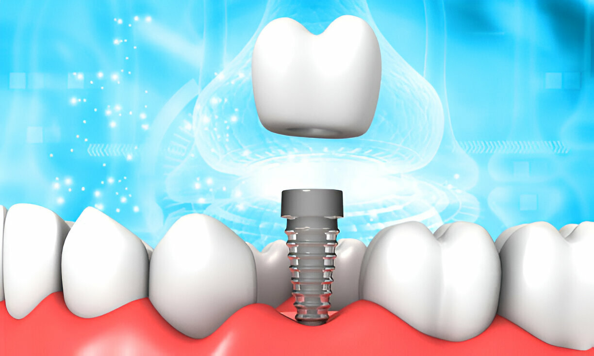 Prime dental 66 dental implants for missing teeth