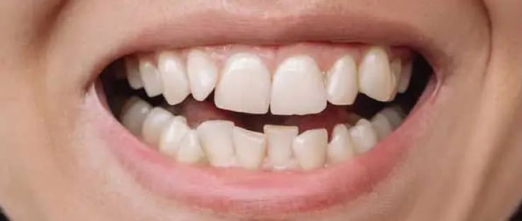 Prime Dental Clear Aligners